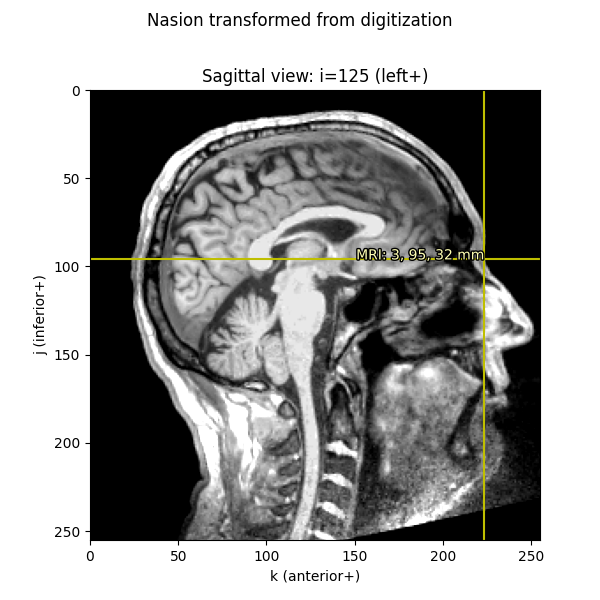 Nasion transformed from digitization, Sagittal view: i=125 (left+)