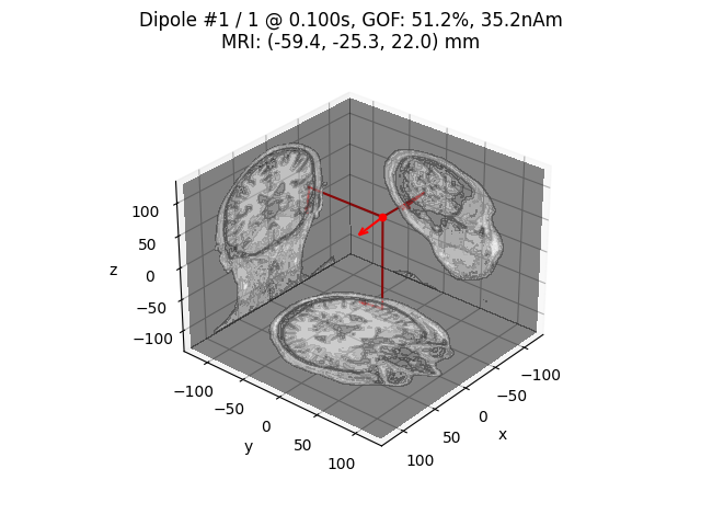 Dipole #1 / 1 @ 0.100s, GOF: 51.2%, 35.2nAm MRI: (-59.4, -25.3, 22.0) mm