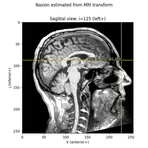 Nasion estimated from MRI transform, Sagittal view: i=125 (left+)
