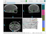 Locating intracranial electrode contacts
