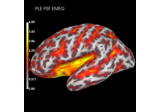 Compute spatial resolution metrics to compare MEG with EEG+MEG