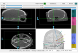 Locating intracranial electrode contacts