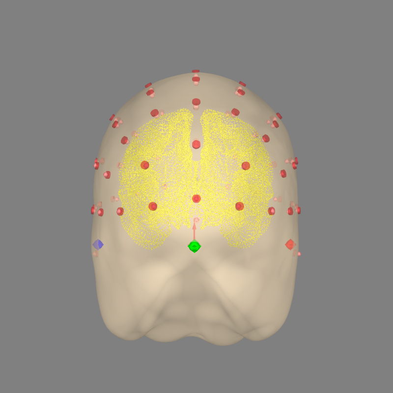 35 eeg no mri