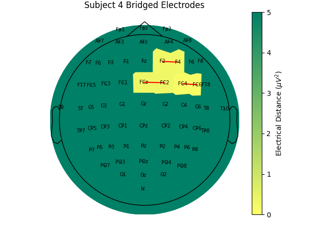 Subject 4 Bridged Electrodes