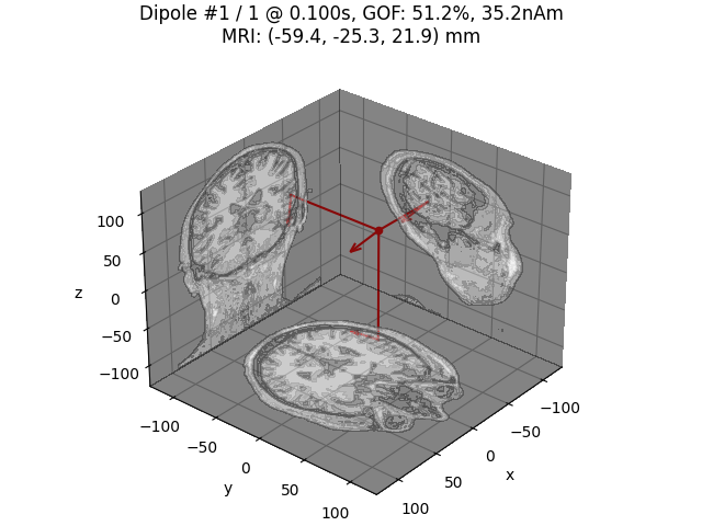 Dipole #1 / 1 @ 0.100s, GOF: 51.2%, 35.2nAm MRI: (-59.4, -25.3, 21.9) mm