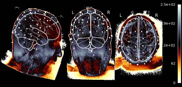70 eeg mri coords