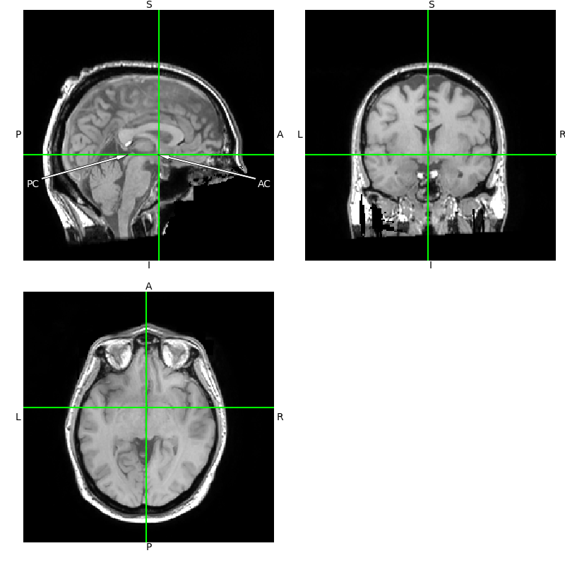 10 ieeg localize