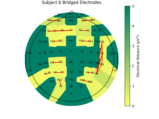 Subject 6 Bridged Electrodes