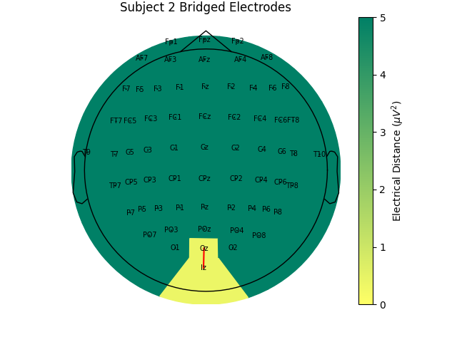 Subject 2 Bridged Electrodes