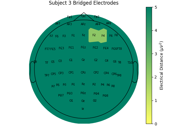 Subject 3 Bridged Electrodes