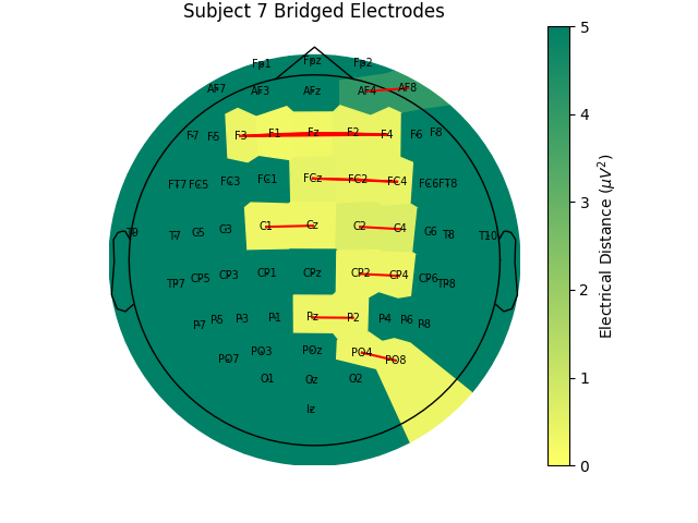 Subject 7 Bridged Electrodes