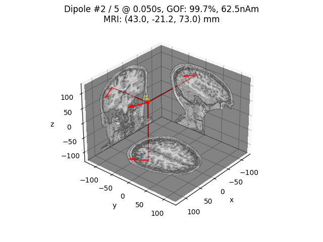 Dipole #2 / 5 @ 0.050s, GOF: 99.7%, 62.5nAm MRI: (43.0, -21.2, 73.0) mm