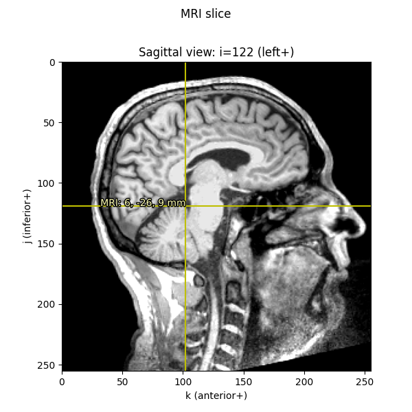 MRI slice, Sagittal view: i=122 (left+)