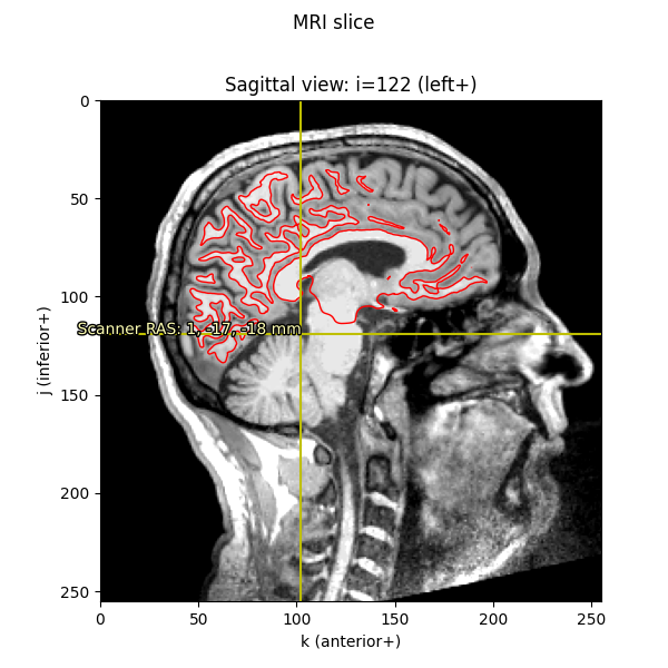 MRI slice, Sagittal view: i=122 (left+)