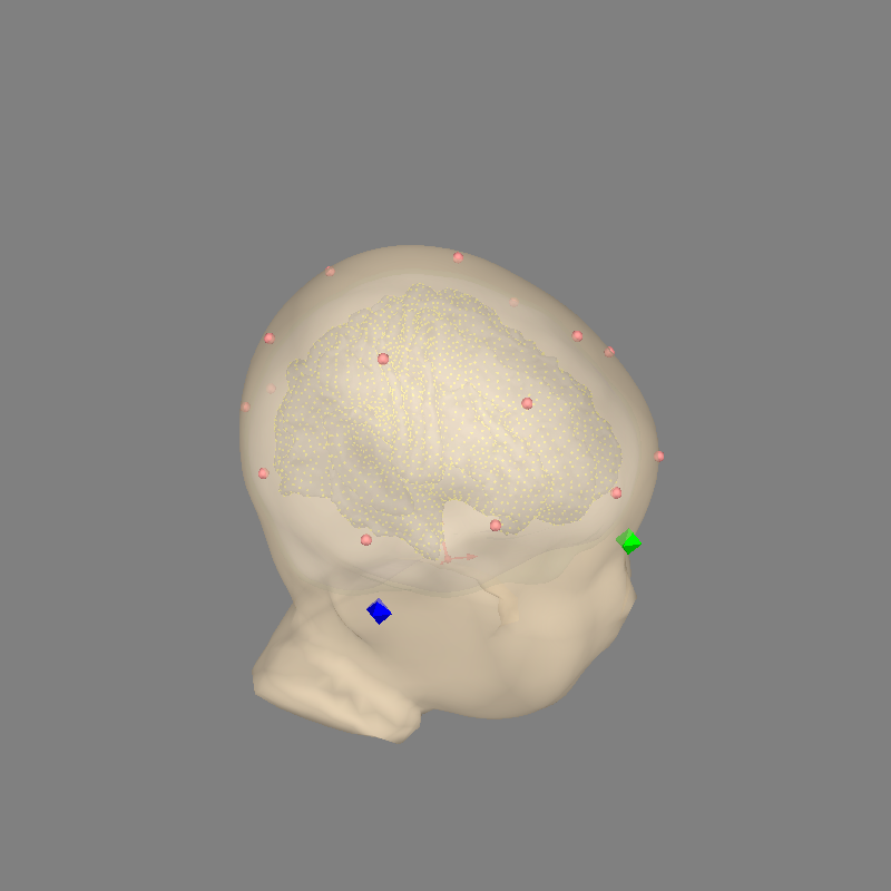 35 eeg no mri