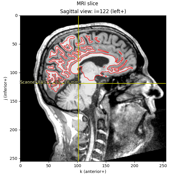 MRI slice, Sagittal view: i=122 (left+)