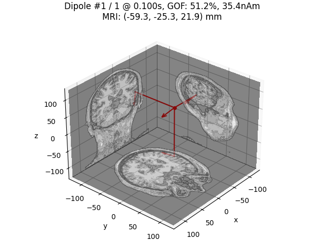 Dipole #1 / 1 @ 0.100s, GOF: 51.2%, 35.4nAm MRI: (-59.3, -25.3, 21.9) mm