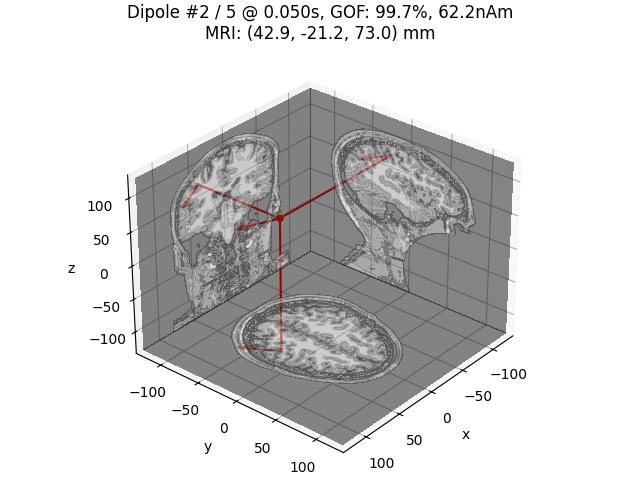 Dipole #2 / 5 @ 0.050s, GOF: 99.7%, 62.2nAm MRI: (42.9, -21.2, 73.0) mm