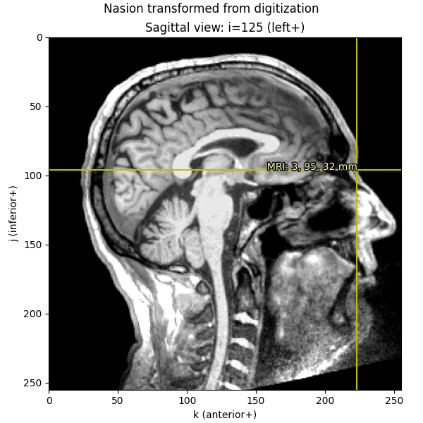 Nasion transformed from digitization, Sagittal view: i=125 (left+)