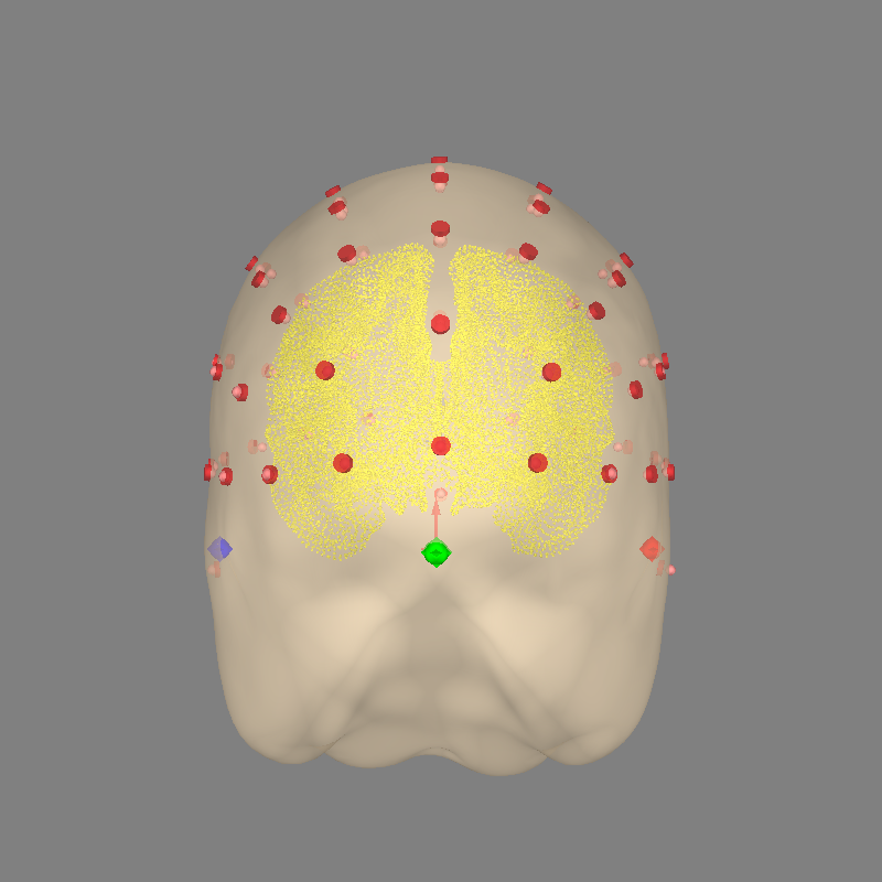 35 eeg no mri