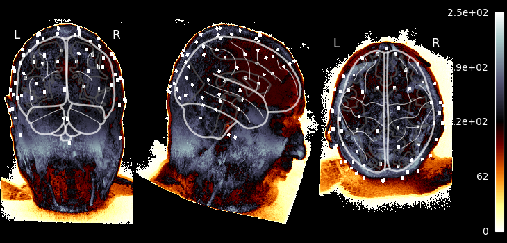 70 eeg mri coords