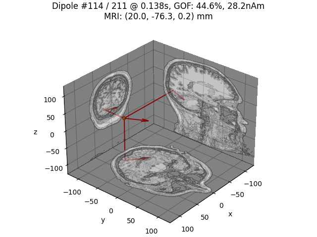 Dipole #114 / 211 @ 0.138s, GOF: 44.6%, 28.2nAm MRI: (20.0, -76.3, 0.2) mm