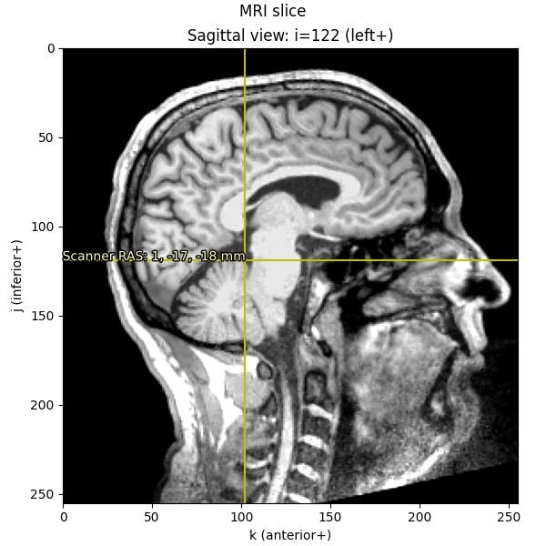 MRI slice, Sagittal view: i=122 (left+)