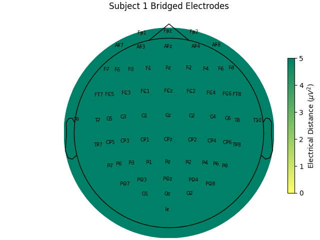 Subject 1 Bridged Electrodes