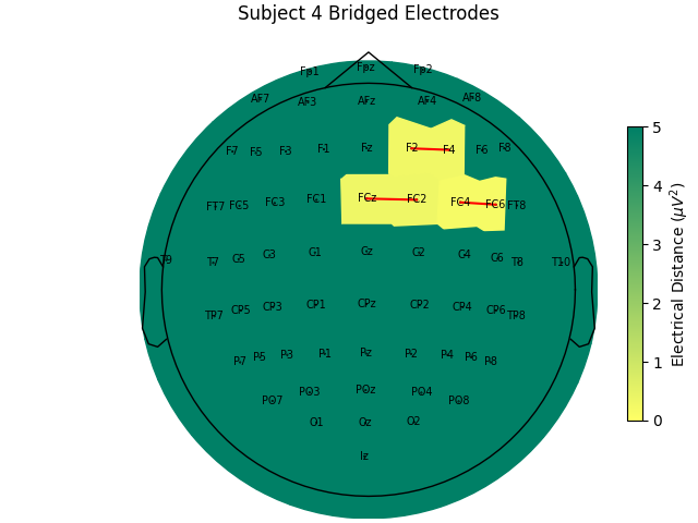 Subject 4 Bridged Electrodes