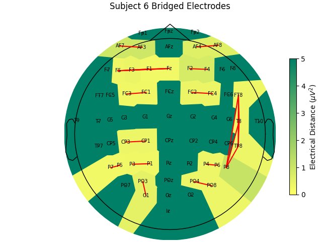 Subject 6 Bridged Electrodes