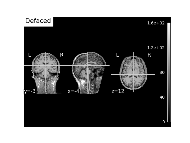 Save and load T1-weighted MRI scan along with anatomical landmarks in ...