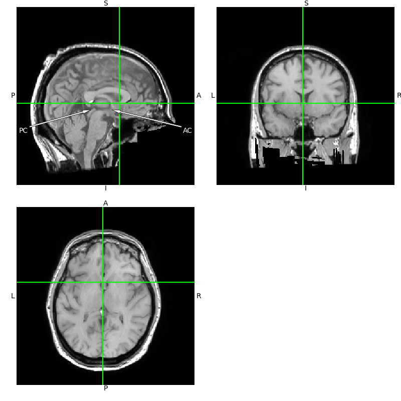 ieeg locate