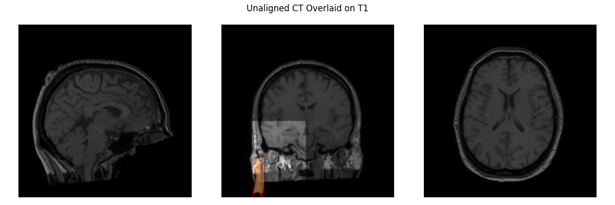 Unaligned CT Overlaid on T1