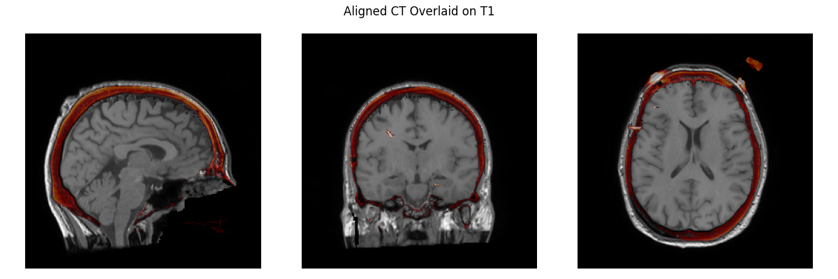 Aligned CT Overlaid on T1