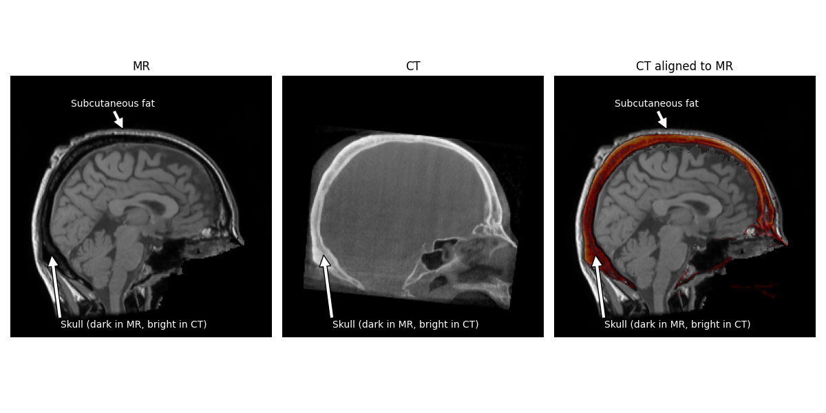 MR, CT, CT aligned to MR