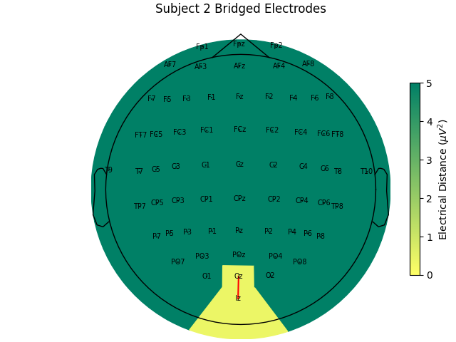 Subject 2 Bridged Electrodes
