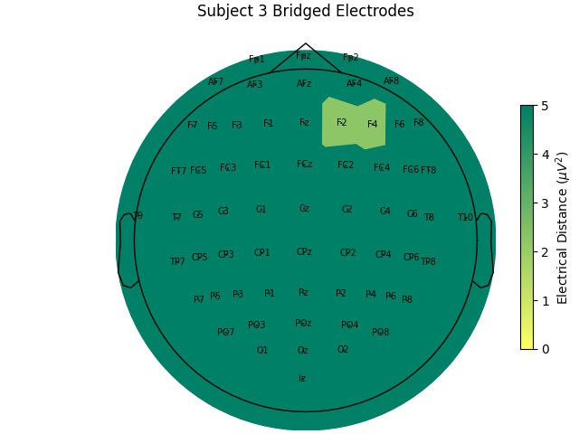 Subject 3 Bridged Electrodes