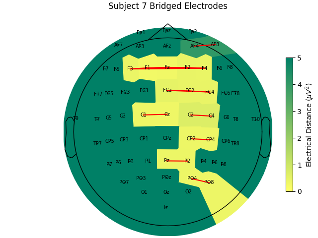 Subject 7 Bridged Electrodes