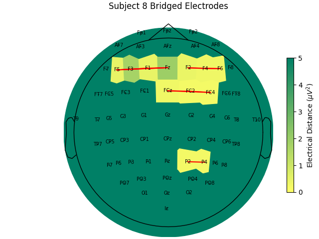 Subject 8 Bridged Electrodes